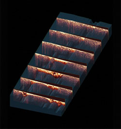 A series of OCT images acquired across a three-dimensional surgical margin that is positive for tumor.